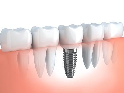 Dental Implants dental implants orlando dental implants near me, dental implant cost/cost of dental implants affordable dental implants