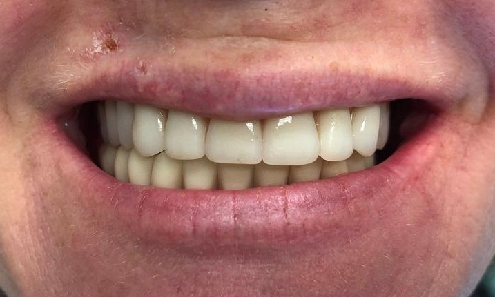 Dentures - After
Dentures, dentures Orlando,
dentures near me,
affordable dentures,
how much do dentures cost?